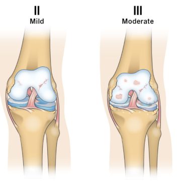End-Stage Arthritis Knee Treatments