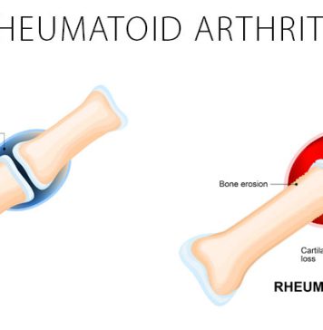 Getting to Know Arthritis Surgery