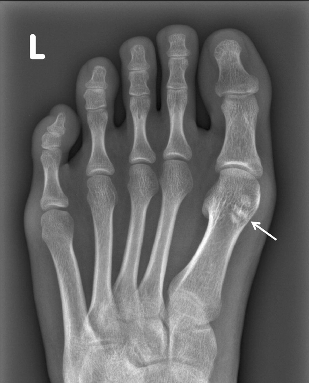 Metatarsal Sesamoid Bone Causes and Treatment - A Little Piece of ...