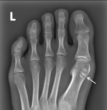Metatarsal Sesamoid Bone Causes and Treatment