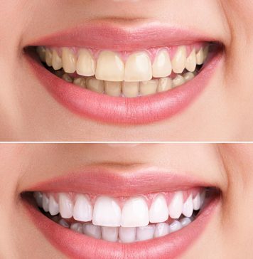 Home Remedies For Teeth Whitening