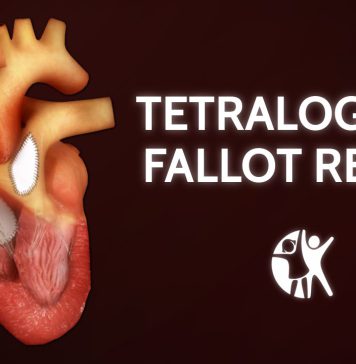 Tetralogy of Fallot Surgery