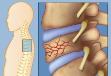 Anterior Wedge Fracture