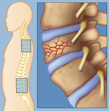 Anterior Wedge Fracture
