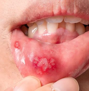 Canker Sores Natural Remedy
